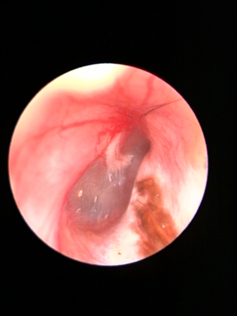 ear-disease-camera-view