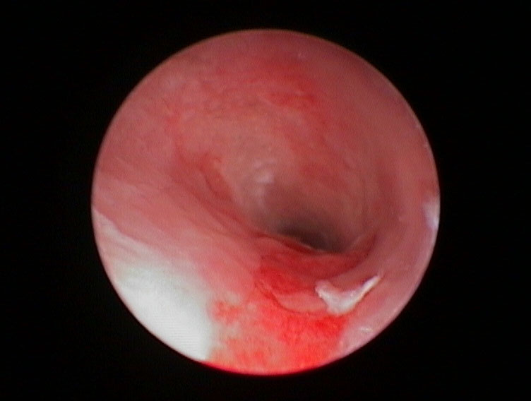 ear-disease-camera-view