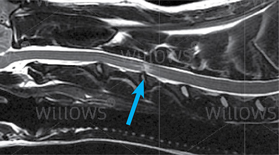 traumatic-disc-extrusion-scan