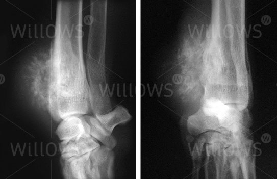 osteosarcoma-x-ray