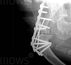 arthrodesis-scan