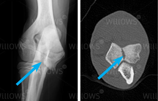 humeral-intracondylar-fissure-scan