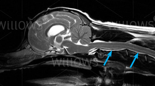 syringomyelia-scan-diagram