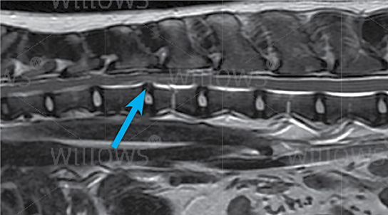 traumatic-disc-extrusion-scan
