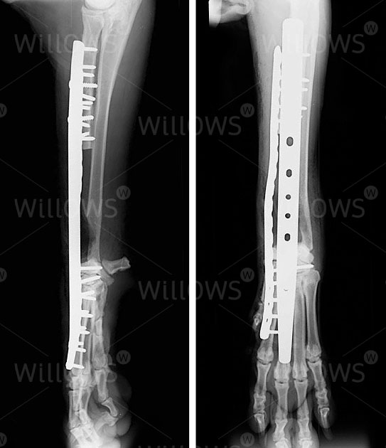 osteosarcoma-x-ray
