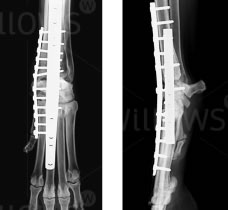 arthrodesis-scan