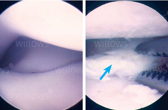 arthroscopy-scan