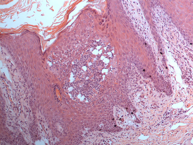 skin-biopsy-close-up