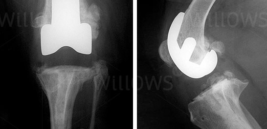 Total Knee Replacement Surgery