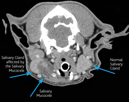 Salivary Mucocele