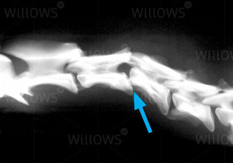 spinal-fracture-scan