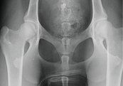 hip-dysplasia-scan