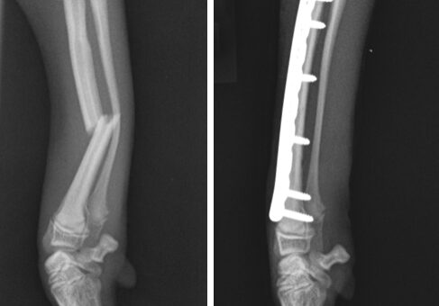 fracture-treatment-scan-break