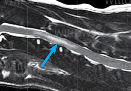 ischaemic-myelopathy-scan