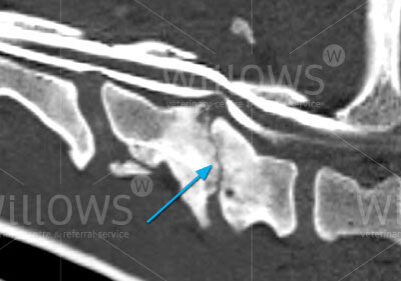 cervical-spondylopathy-scan