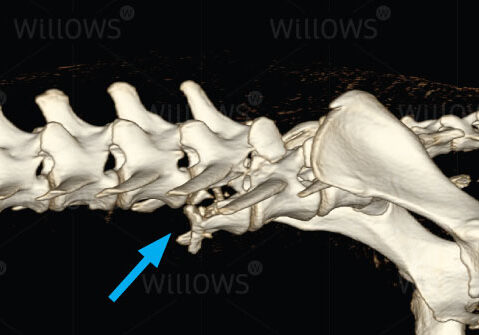 spinal-fracture-diagram