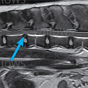 traumatic-disc-extrusion-scan