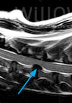 cervical-disc-disease-scan-diagram