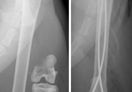 fracture-treatment-scan-break