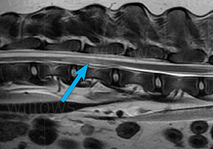 ischaemic-myelopathy-scan