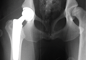 total-hip-replacement-surgery-scan