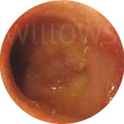 inflammatory-bowel-disease-camera-view