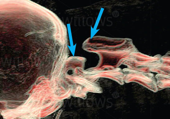 atlanto-axial-scan-diagram