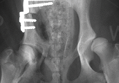 hip-dysplasia-scan