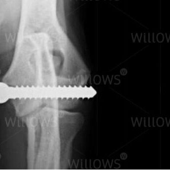 humeral-intracondylar-fissure-screw-scan