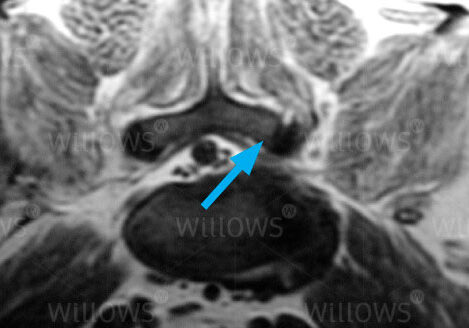 lumbosacral-disease-scan