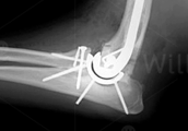 total-elbow-replacement-surgery-scan