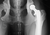 total-hip-replacement-surgery-scan