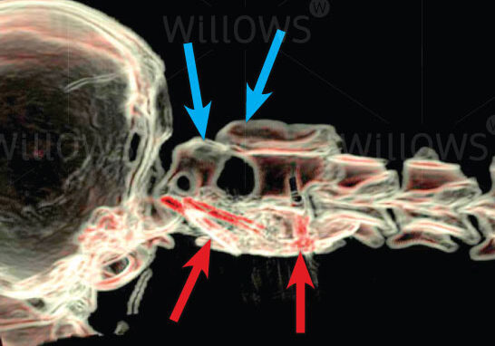 atlanto-axial-scan-diagram