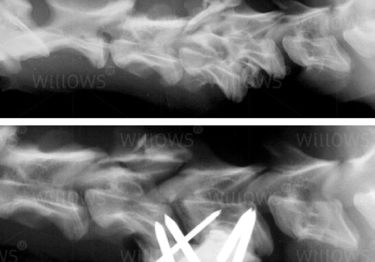 spinal-fracture-scan