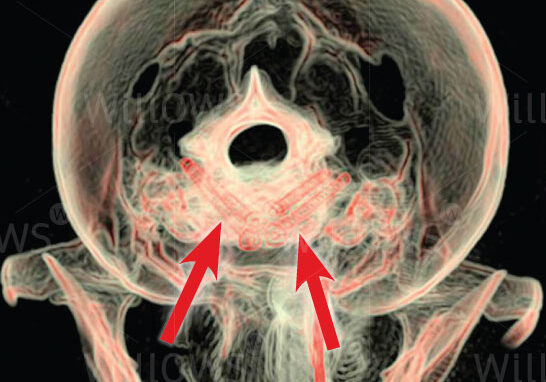 atlanto-axial-scan