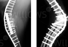 arthrodesis-scan