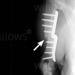 elbow-dysplasia-scan