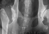 hip-dysplasia-scan