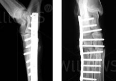 arthrodesis-scan