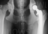 hip-dysplasia-scan