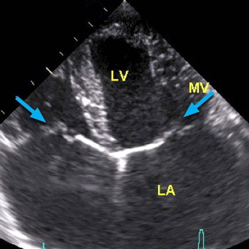 heart-murmur-scan-diagram