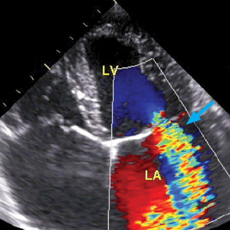 heart-murmur-scan-diagram