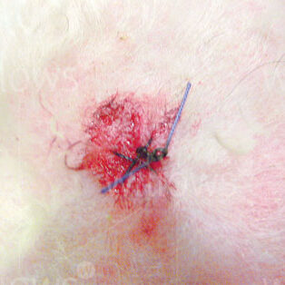 skin-biopsy-stitching
